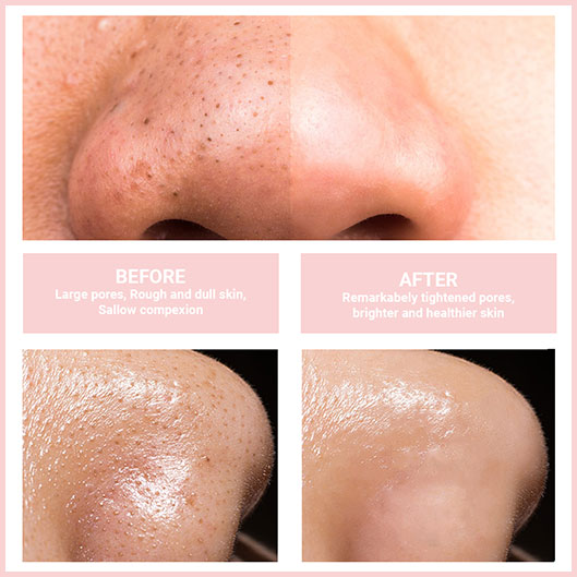 Instant Clear and Smooth Skin in Minutes Daily
