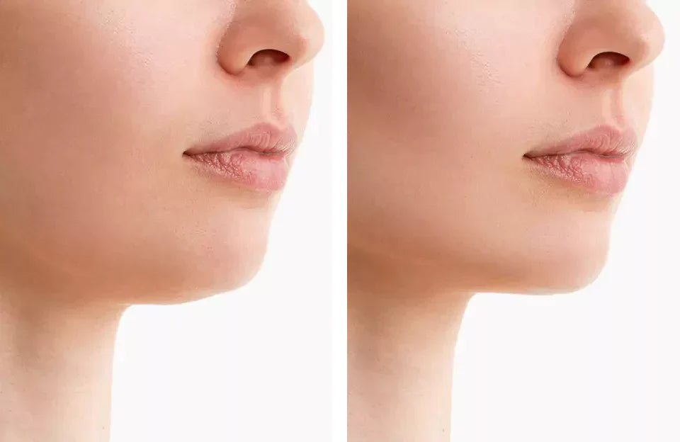 Red Light Belt for Double Chin Contouring
