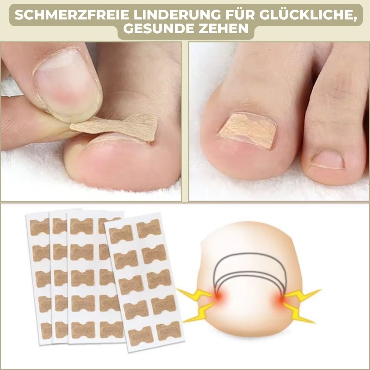 Ingrown Nail Correction Strips for Pain-Free Alignment