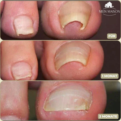 Ingrown Nail Correction Strips for Pain-Free Alignment