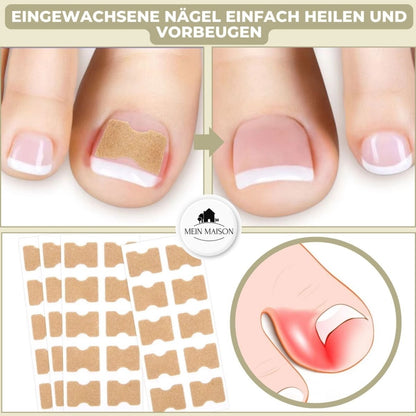 Ingrown Nail Correction Strips for Pain-Free Alignment