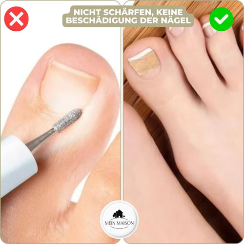 Ingrown Nail Correction Strips for Pain-Free Alignment