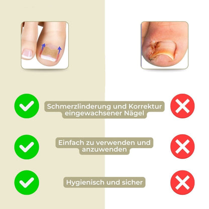 Ingrown Nail Correction Strips for Pain-Free Alignment