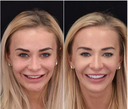Snap-On Veneers for Upper and Lower Teeth – Quick Natural Smile Solution