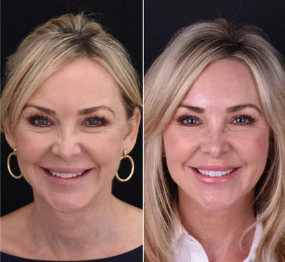 Snap-On Veneers for Upper and Lower Teeth – Quick Natural Smile Solution
