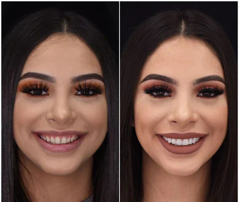 Snap-On Veneers for Upper and Lower Teeth – Quick Natural Smile Solution
