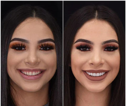 Snap-On Veneers for Upper and Lower Teeth – Quick Natural Smile Solution