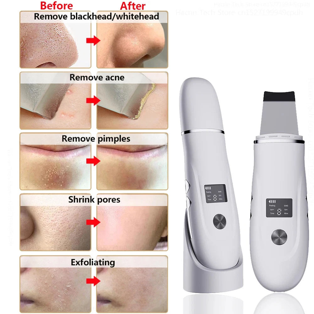 Ultrasonic Skin Scrubber for Deep Cleansing