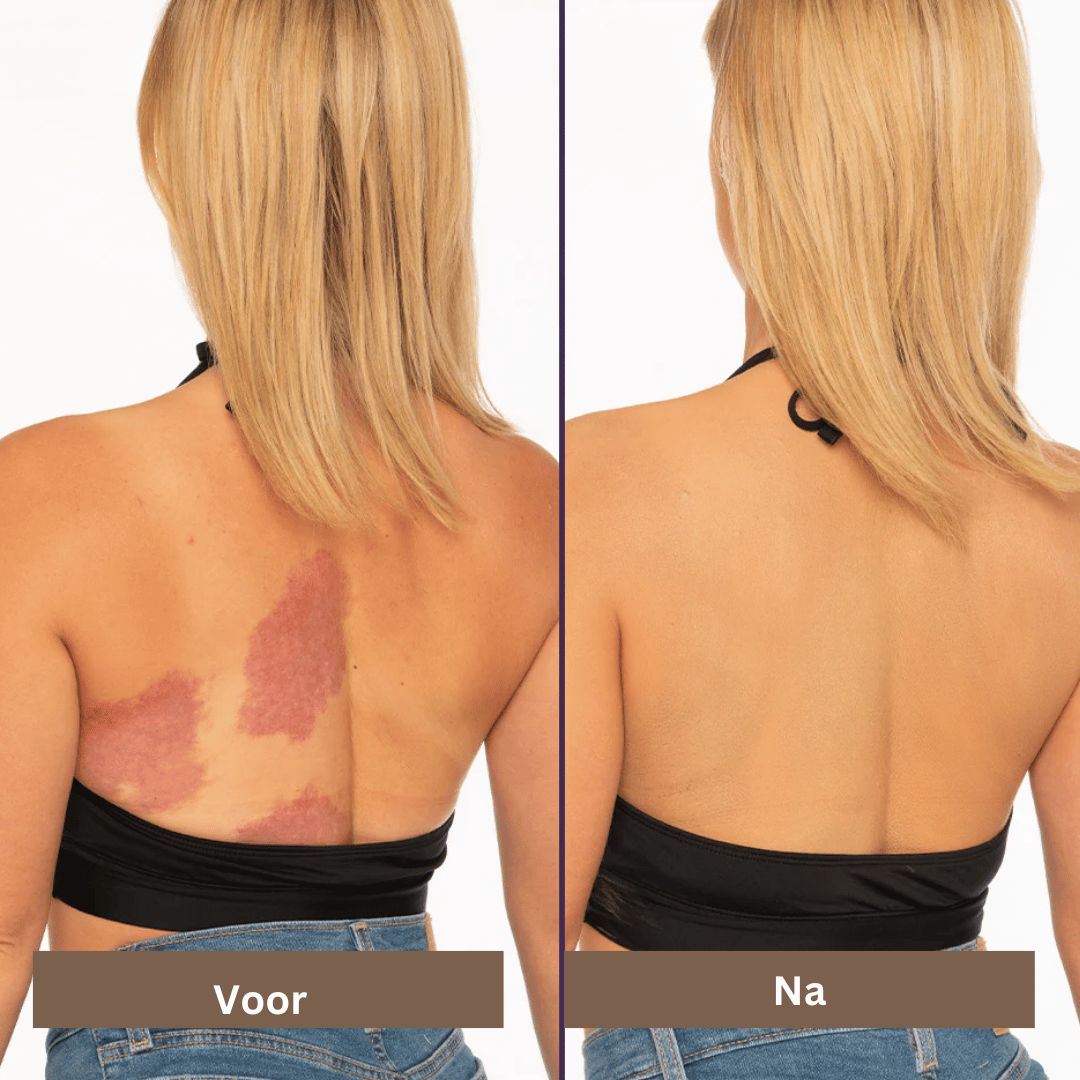 Skin Care Solution for Covering Scars, Veins, Acne, and Sunspots