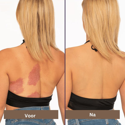 Skin Care Solution for Covering Scars, Veins, Acne, and Sunspots