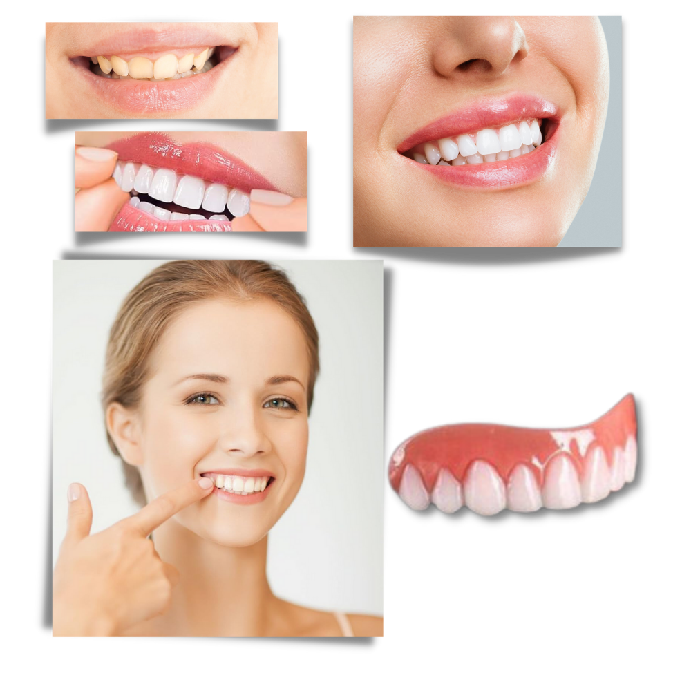 Snap-On Dental Veneers for Instant Smile Enhancement